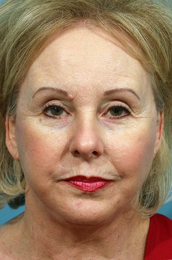 Chin Implant after 633285