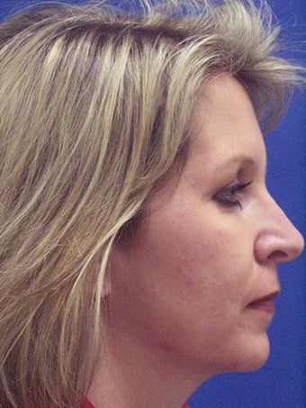 Chin Augmentation, Revision Rhinoplasty, and Facial Rejuvenation before 250133