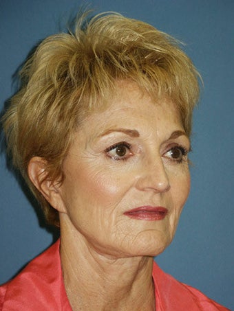 Chin augmentation with facial rejuvenation before 250162