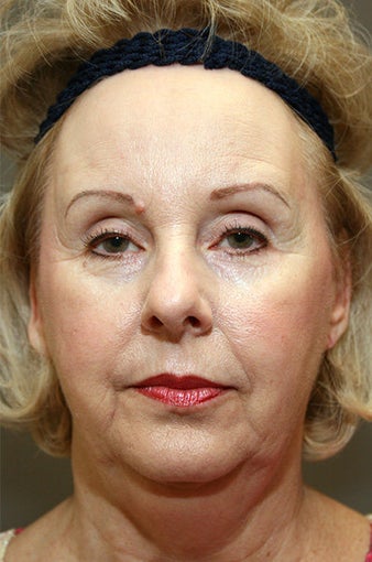 Chin Implant before 633285