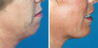 Chin Implant before 642997