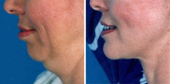 Chin Implant before 643003