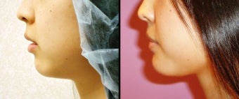 Chin Augmentation before 649413