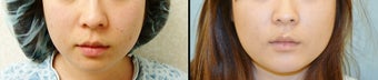 Chin Augmentation before 649428