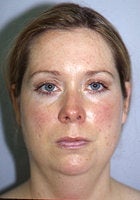 Before and After Chin Implant With Liposuction (Front View) before 65320