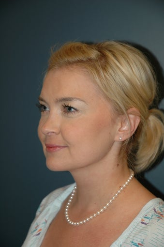 After Neck liposuction after 74996