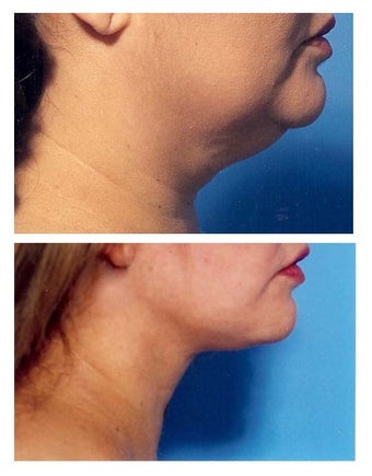 Chin Liposuction before 640693