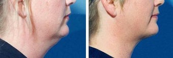 Chin Liposuction before 640709