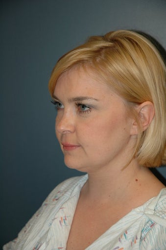 After Neck liposuction before 74996