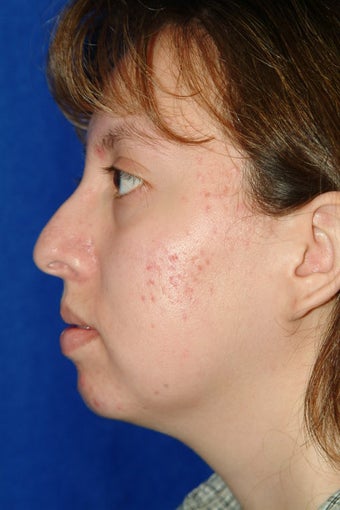 Rhinoplasty, chin implant, chin liposculpture, cheek fat pad removal before 83394