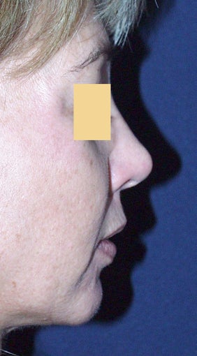 Chin Augmentation after 365458