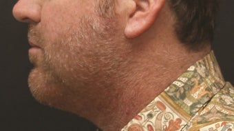 Chin Implant and Laser-Assisted Lipocontouring of Neck after 406765