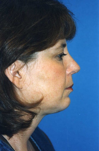 Chin Implant after 409961