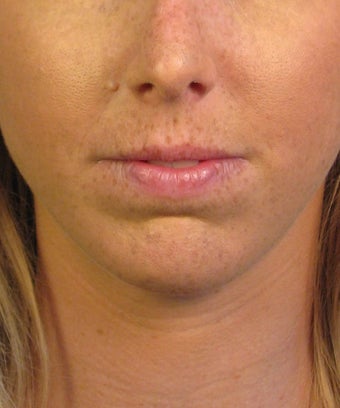 Chin Implant after 414153