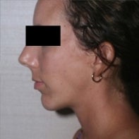 Chin Implant after 448770
