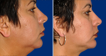 Chin Implant after 495867