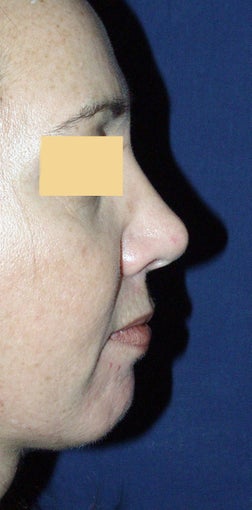 Chin Augmentation before 365458
