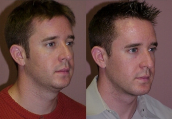 Chin Augmentation With Submental Liposuction before 381157