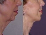 Chin Implant before 381160