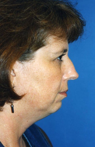 Chin Implant before 409961