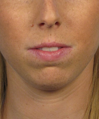 Chin Implant before 414153