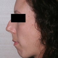 Chin Implant before 448770