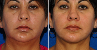 Chin Implant before 495867
