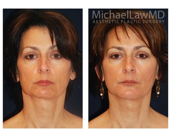 Chin Liposuction before 391524