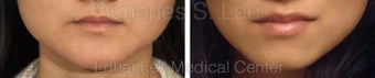 Jaw before 431362