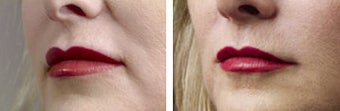 Collagen injection for mouth lines