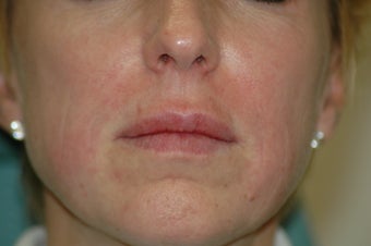 Lip augmentation