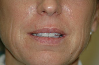 Lip augmentation