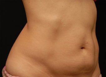 Body contouring after 380980