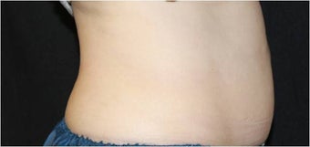 CoolSculpting after 422542