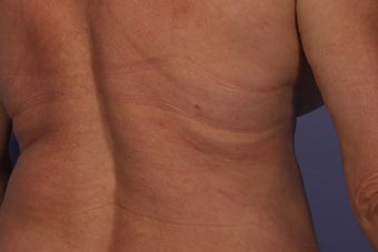 CoolSculpting to Bra/Back Rolls after 429657