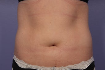 CoolSculpting to Abdomen after 429672