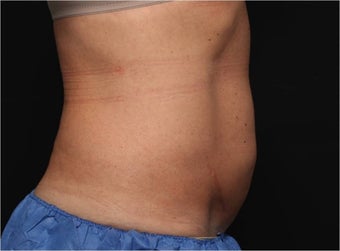 NonInvasive Fat Removal with CoolSculpting - Invented by Dr. Dieter Manstein after 442124