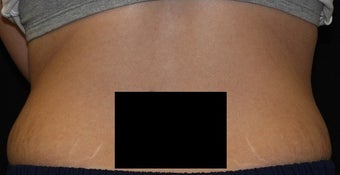 Coolsculpting - Flanks after 445740