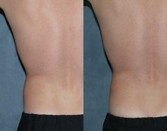 Zeltiq for fat reduction on "love handles" before 183873