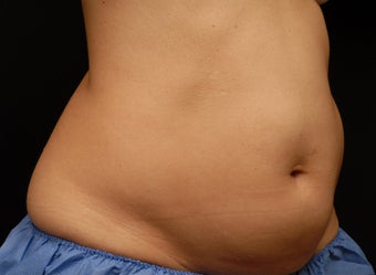 Body contouring before 380980
