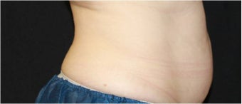 CoolSculpting before 422542