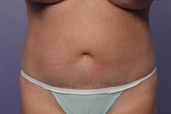 CoolSculpting before 429620