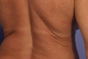 CoolSculpting to Bra/Back Rolls before 429657