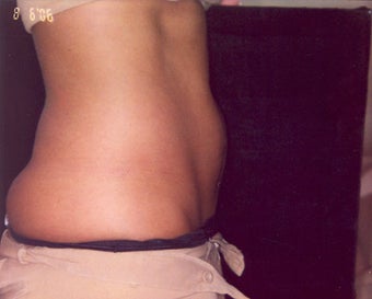 Coolsculpting Treatment before 469317