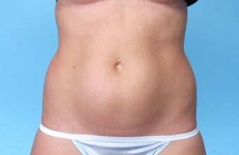 CoolSculpting before 506622