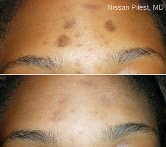 Cosmelan with SaliPeel before 110223
