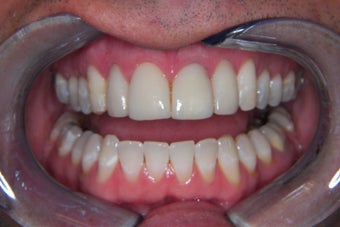 dental crown after 300622