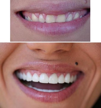 Full porcelain crowns before 109489