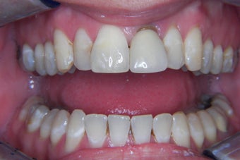 dental crown before 300622
