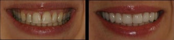 Smile Makeover with Veneers before 58927